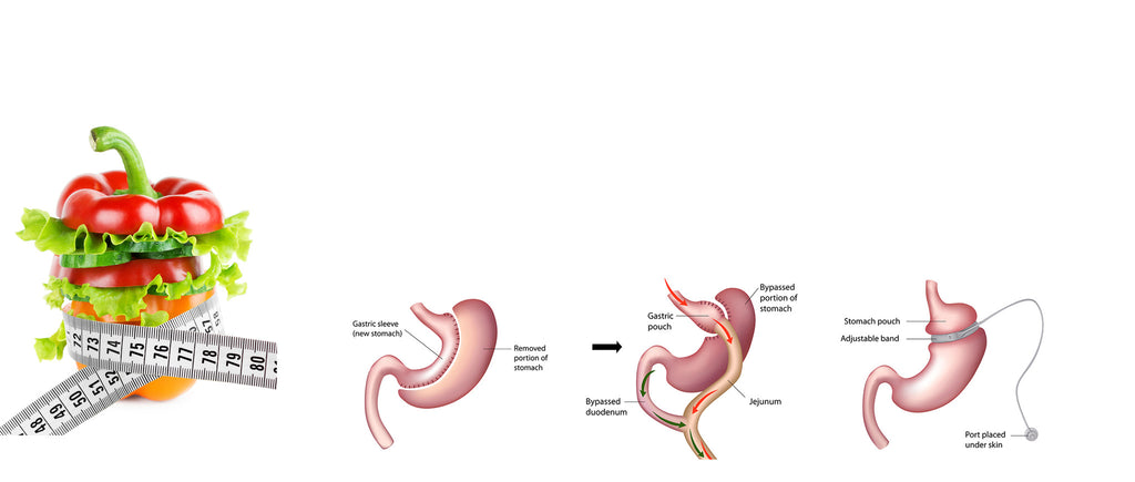 5 Reasons Why Weight Loss Surgery isn't the 'Easy' Option